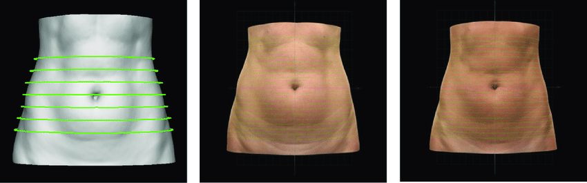 Fig. 3 — Abdominal volume reduction in a patient of the trial