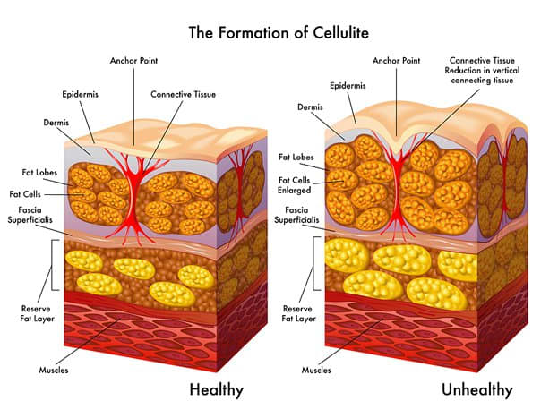 The formation of cellulite