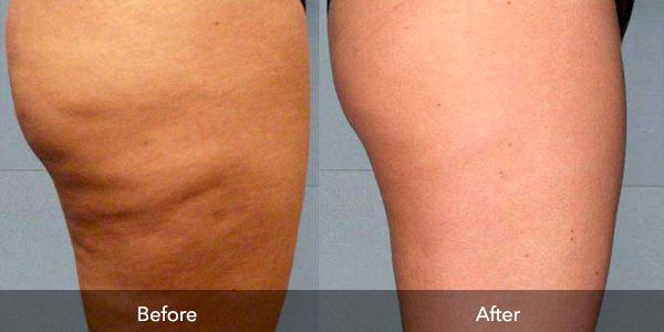 The result of cellulite treatment with a laser with a wavelength of 1440 nm