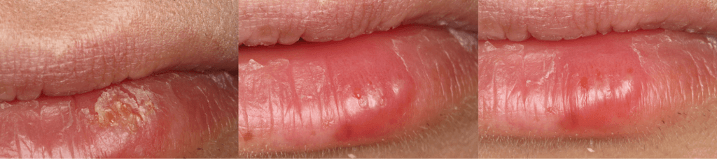 Treating herpes with cold laser therapy