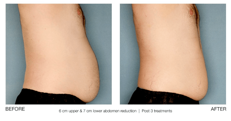 ultrasonic cavitation before and after belly fat