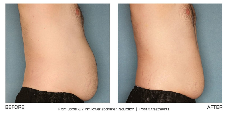 ultrasonic cavitation before and after belly fat