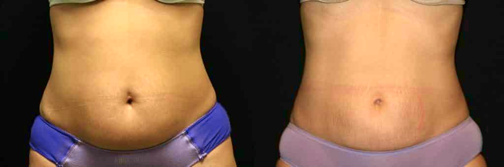 microlaser body sculpting