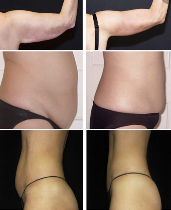 Sono Bello smart lipo treatments