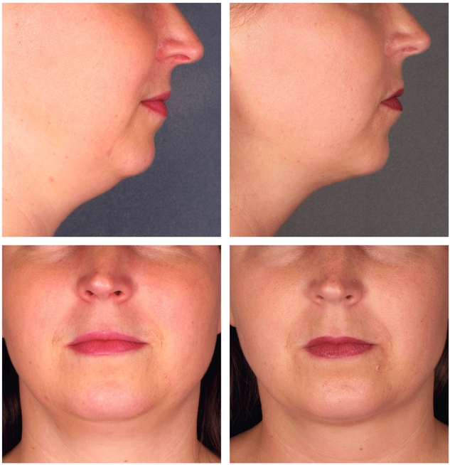 Chin fat removal