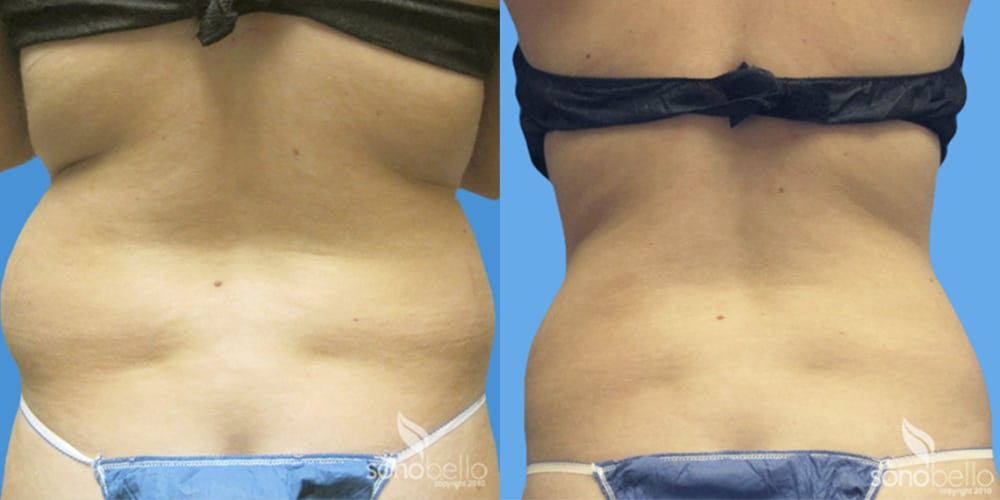 Laser fat removal