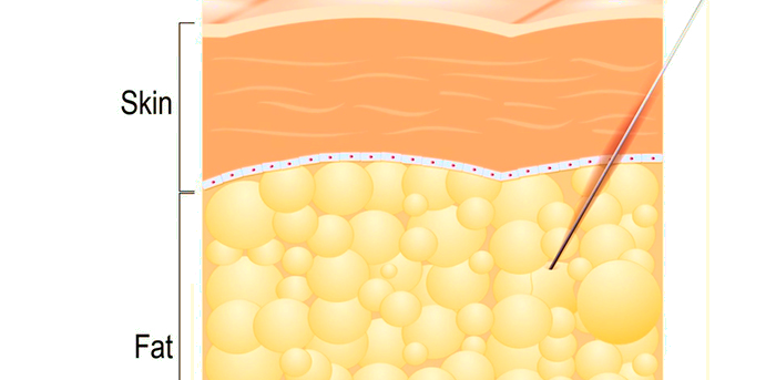 Microlaser body sculpting technique