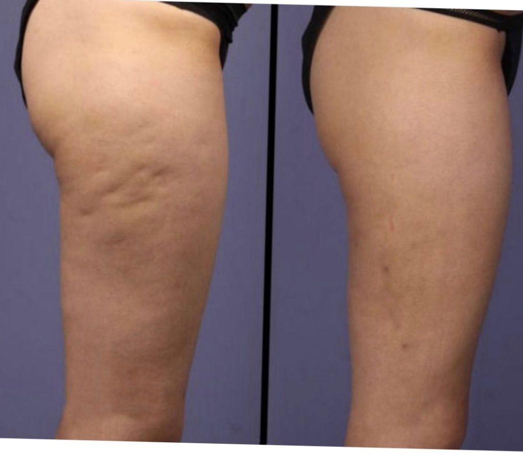 Cellulite reduction