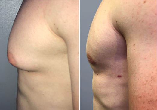 Male chest reduction