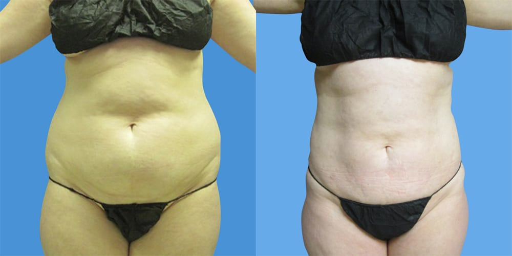 Tummy tuck alternative