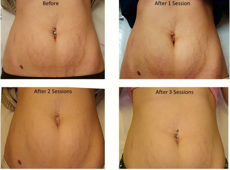 Before/after laser stretch mark treatment on the abdomen