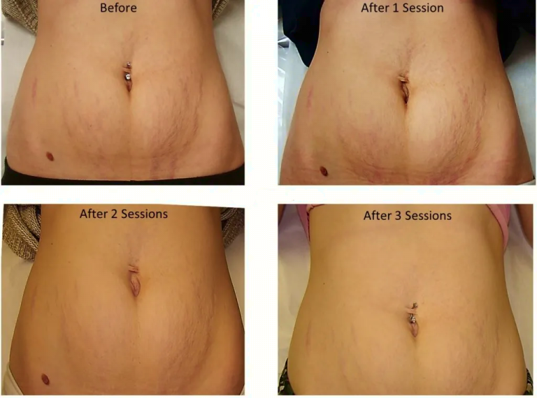 Laser Stretch Mark Removal Doctor’s Review Before And After Heliotherapy Research Institute