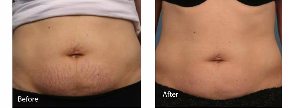 Before/after laser treatment for stretch marks on the abdomen