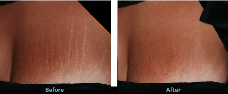 Laser stretch mark removal