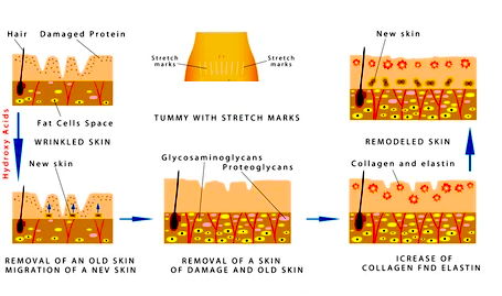 Laser stretch mark removal