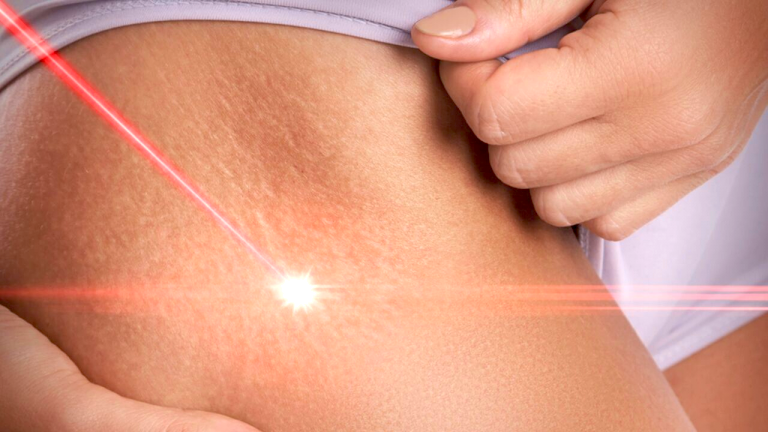 Laser stretch mark removal