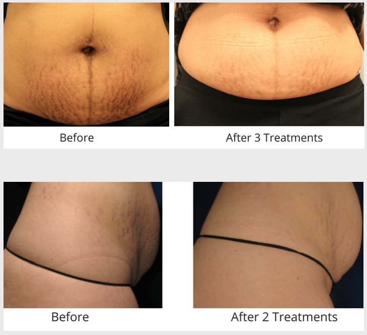 Before/after laser treatment for stretch marks on the abdomen and waist