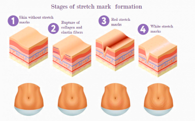 Stages of stretch mark formation