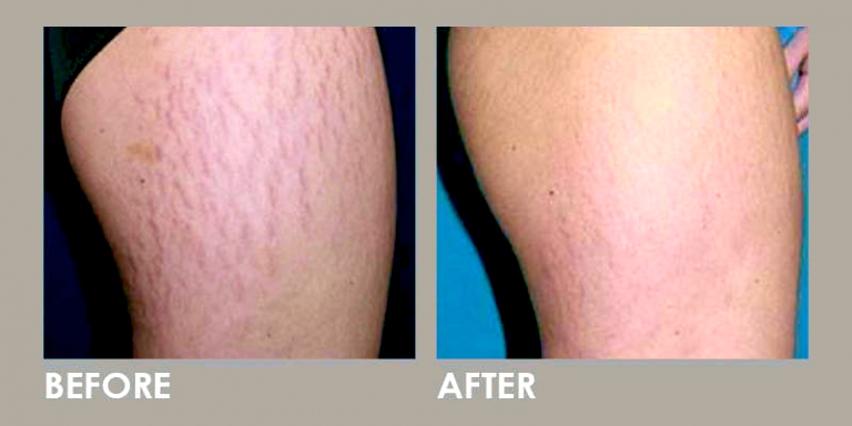 Before/after laser treatment for stretch marks on thighs
