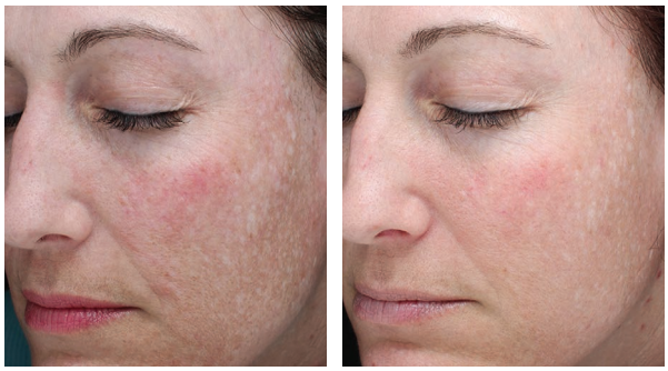 The result of Halo laser treatment after one procedure