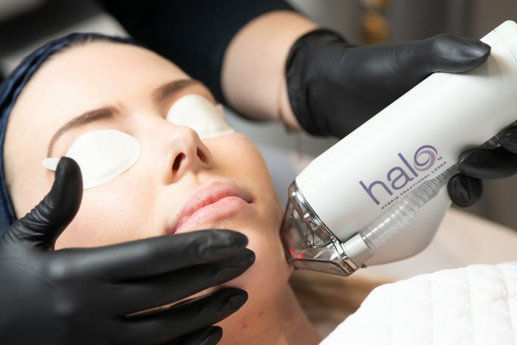 Halo laser treatment review