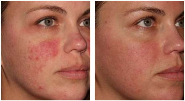 The result of Halo laser treatment after two procedures