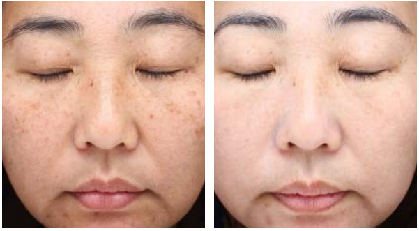 The result of Halo laser treatment after two procedures