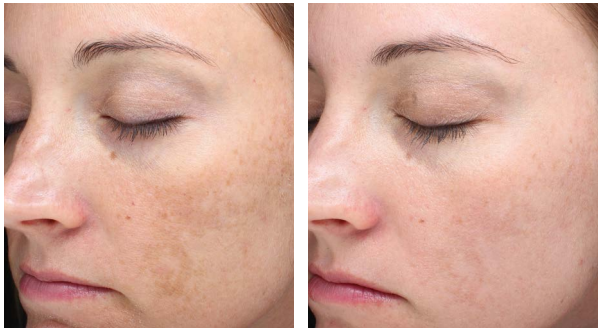 The result of Halo laser treatment after one procedure