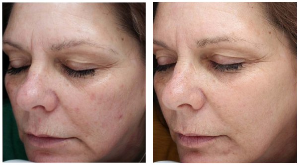 The result of Halo laser treatment after one procedure