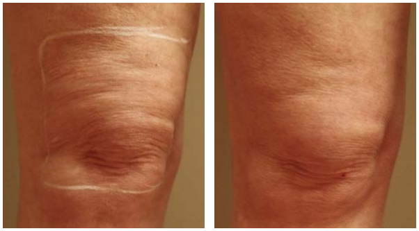 The result of Halo laser treatment after one procedure