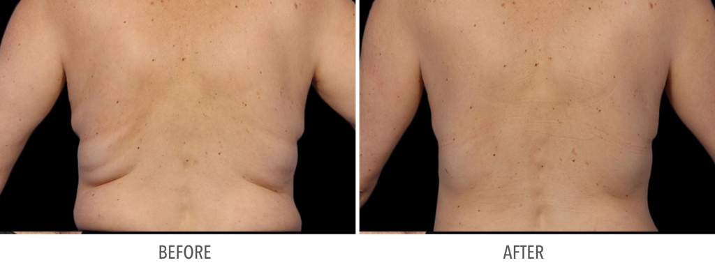 coolsculpting-before-and-after