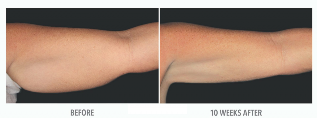 coolsculpting-before-and-after