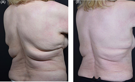 coolsculpting-before-and-after