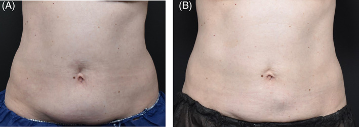 coolsculpting-before-and-after