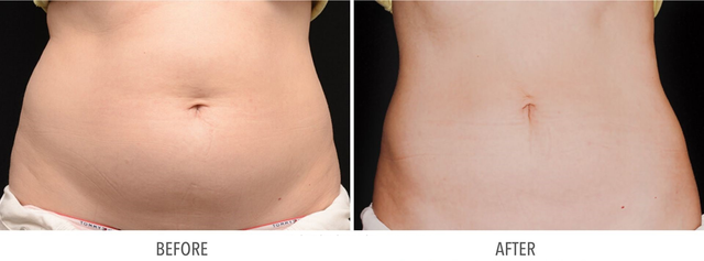 coolsculpting-before-and-after