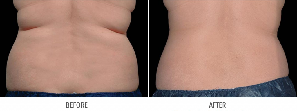 coolsculpting-before-and-after