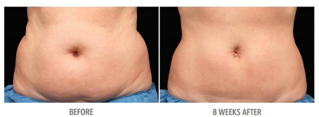 coolsculpting-before-and-after