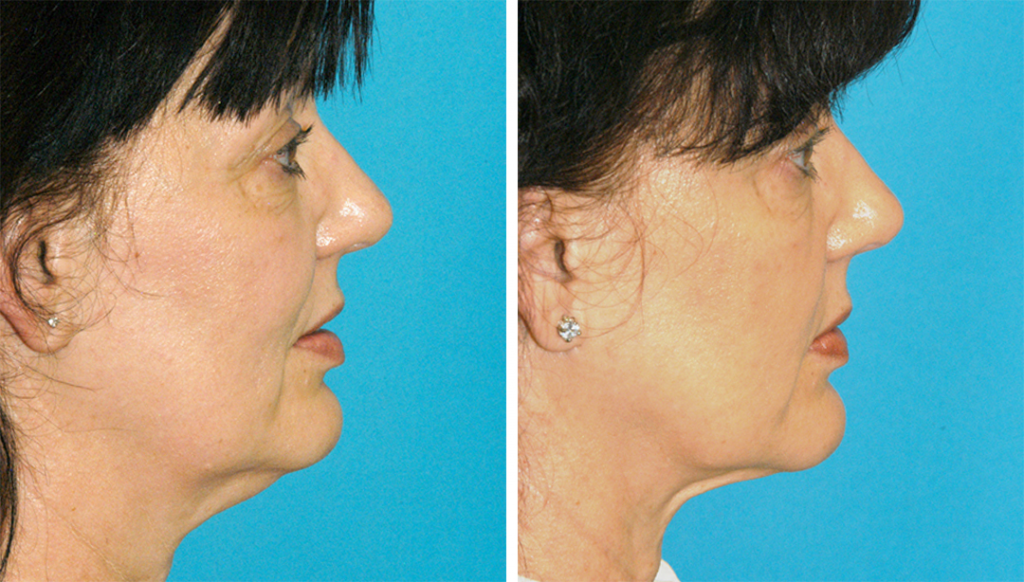 Before and after using Smart lipo for the double chin treatment