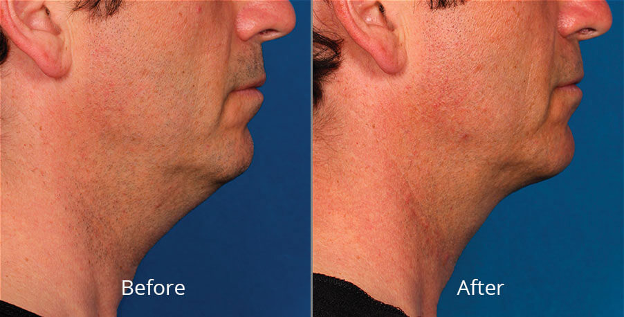 Before and after using mesotherapy for the double chin treatment