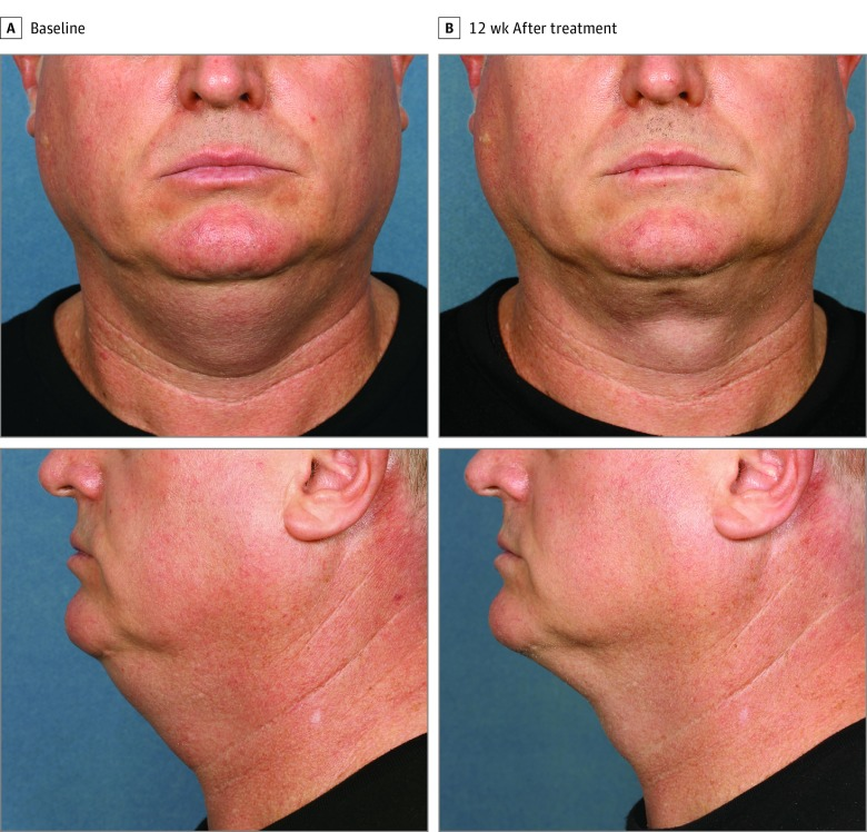 Before and after using CoolSculpting for the double chin treatment