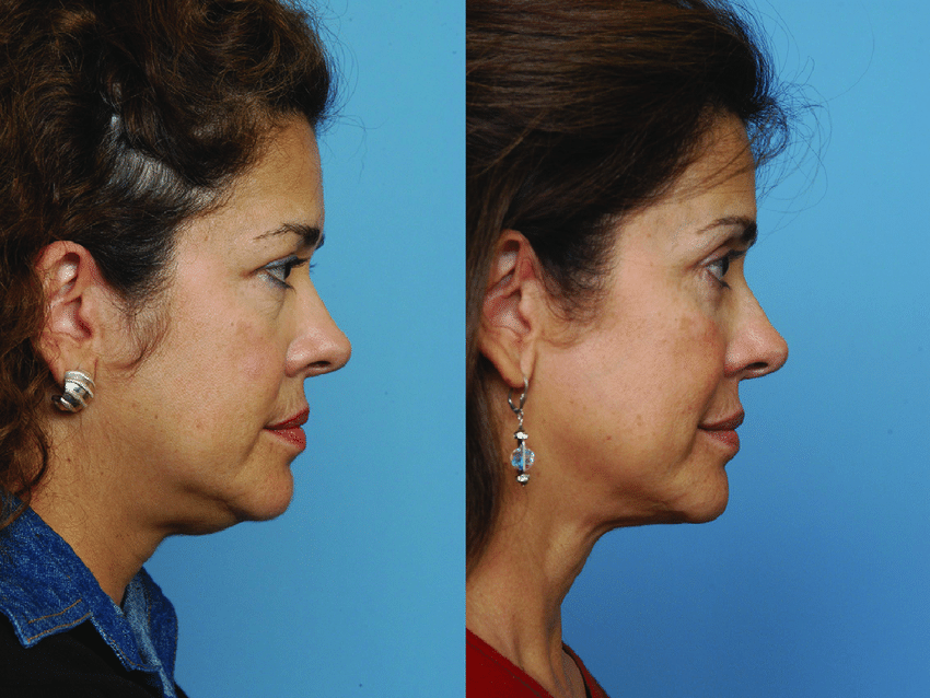 Before and after using Smart lipo for the double chin treatment