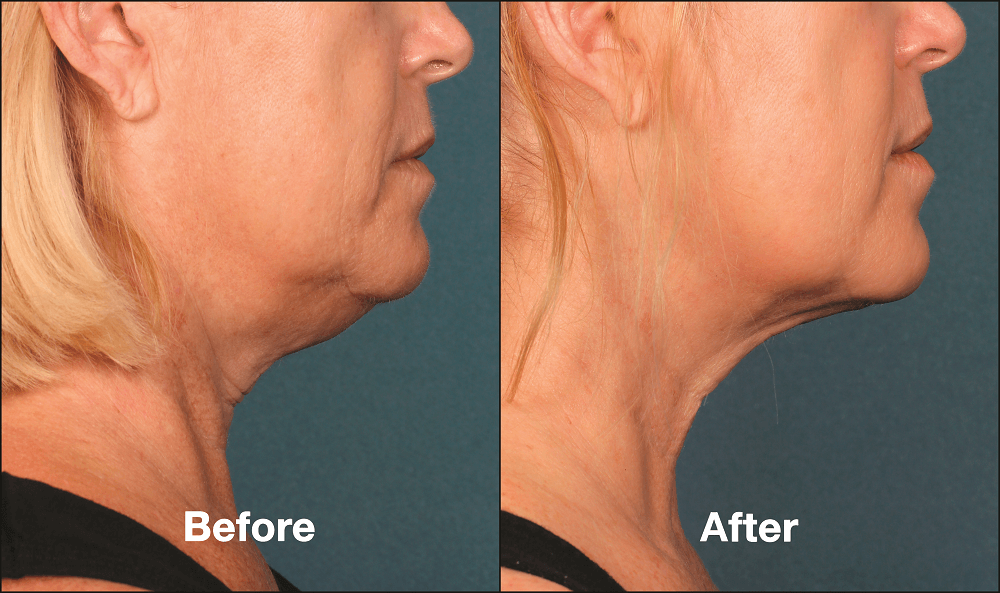 Before and after using mesotherapy for the double chin treatment
