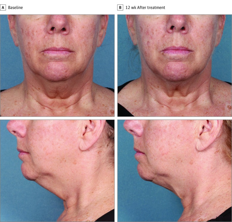 Before and after using CoolSculpting for the double chin treatment