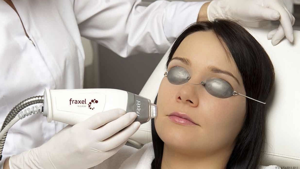 Fraxel laser treatment