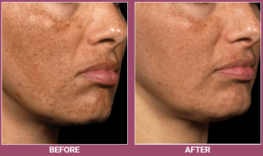 The result of the treatment of hyperpigmentation after the Fraxel procedure