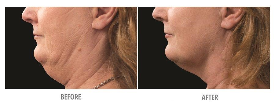 Before and after CoolSculpting treatment