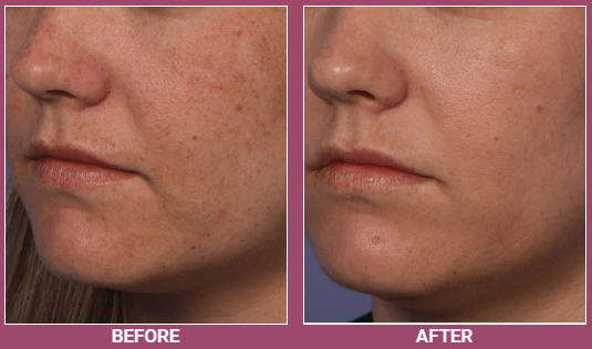 The result of the treatment of hyperpigmentation after the Fraxel procedure