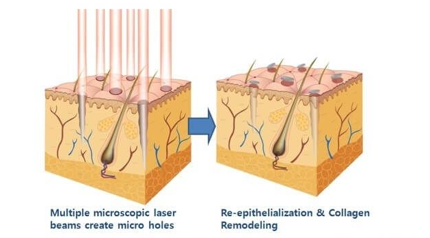 fractional laser