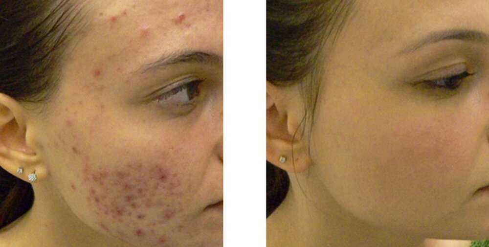 Before/after results of using light therapy for acne treatment