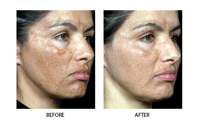 Result of fractional laser treatment